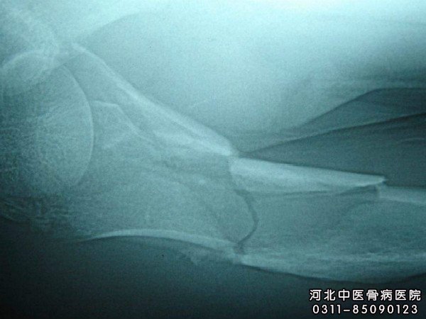 骨不连