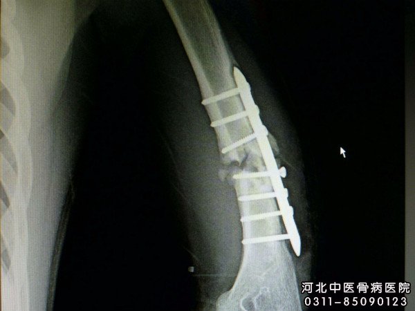 骨不连