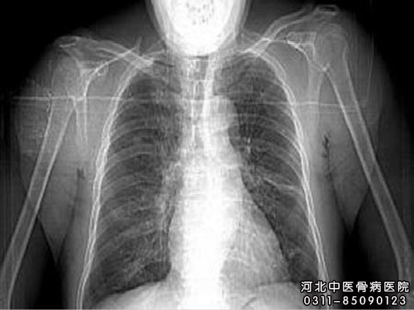 骨结核