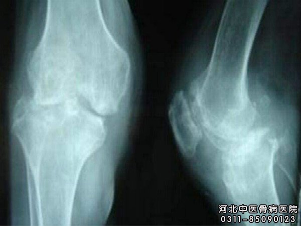 骨结核