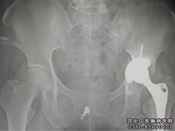 骨结核