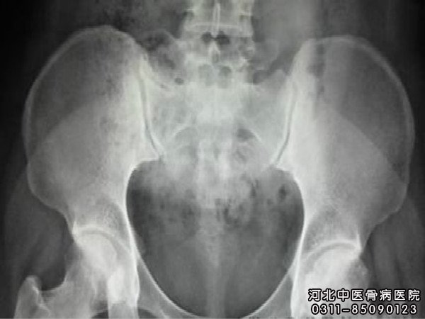 股骨头坏死
