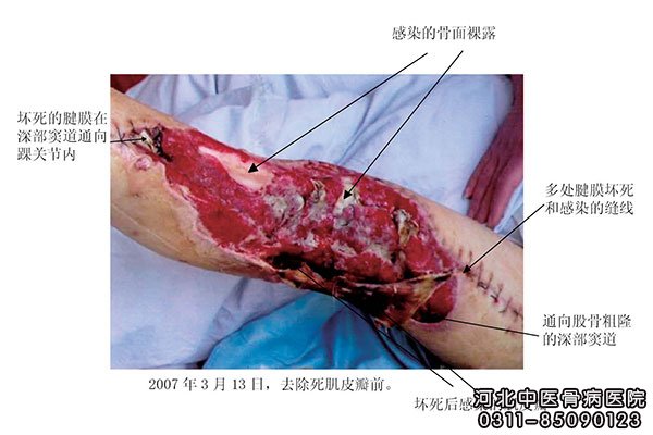 骨髓炎临床表现