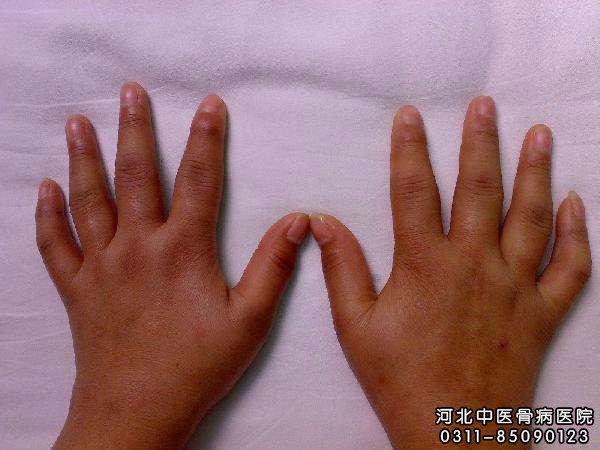 慢性关节炎