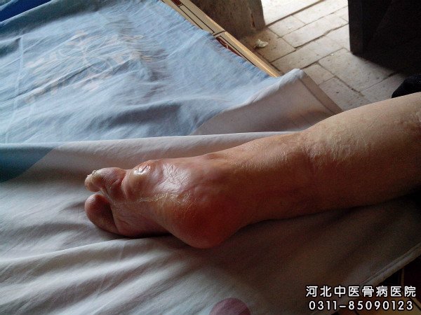 骨髓炎