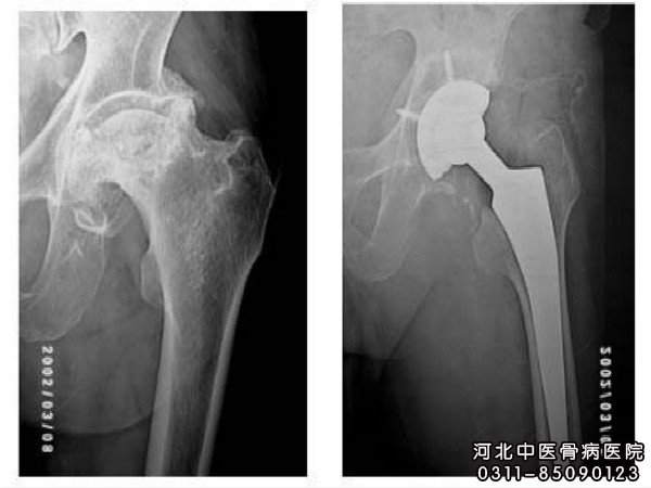 股骨头坏死