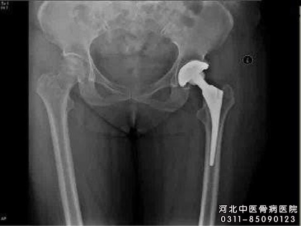 股骨头坏死