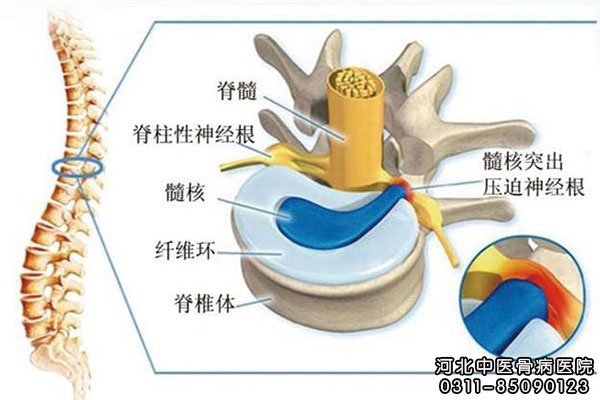 颈椎间盘突出三维示意图