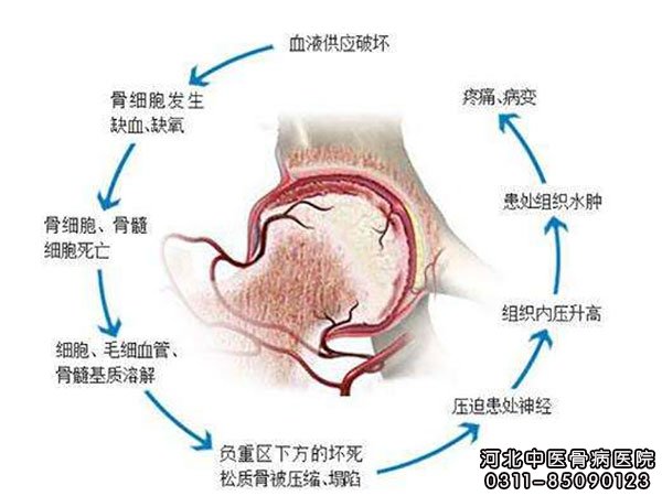 股骨头坏死因素示意图
