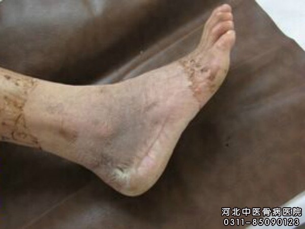 外伤骨髓炎