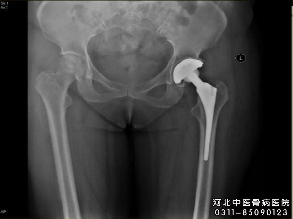 股骨头坏死
