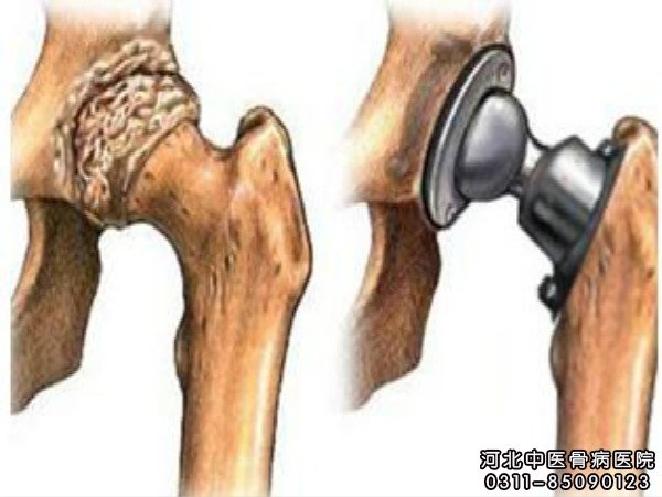 股骨头坏死