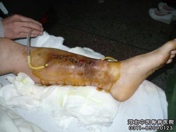骨髓炎