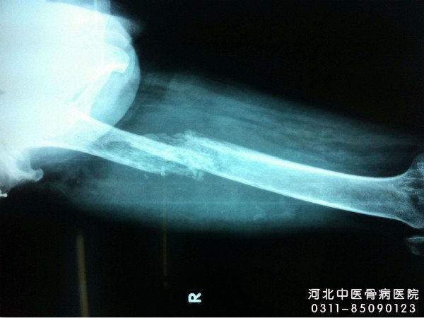 化脓性骨髓炎