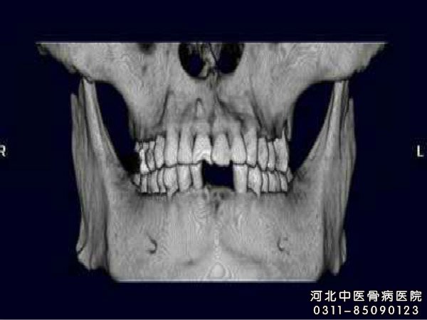 颌骨骨髓炎