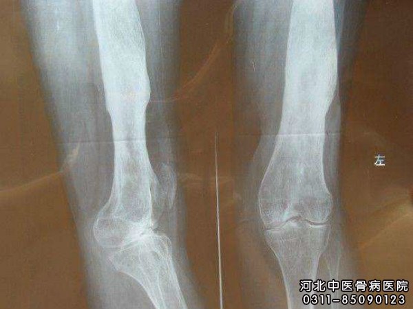 化脓性骨髓炎
