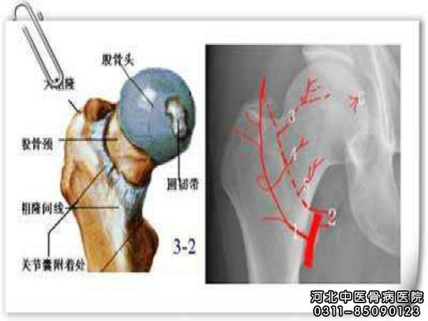 股骨头坏死