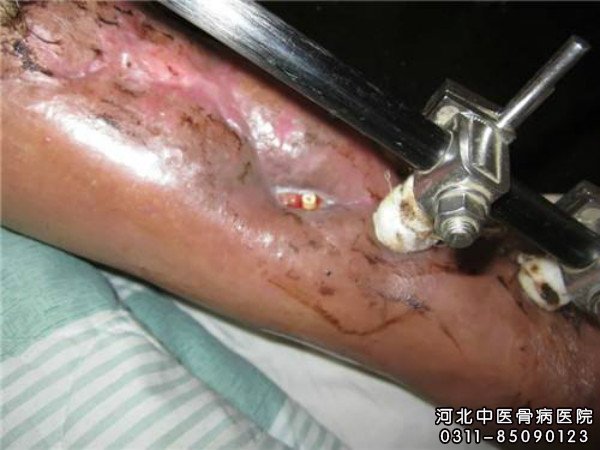 骨髓炎