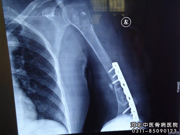 骨不连