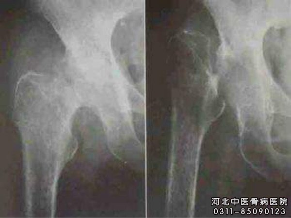 骨结核