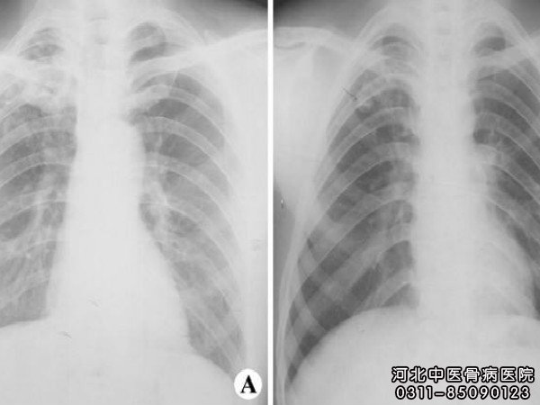 骨结核