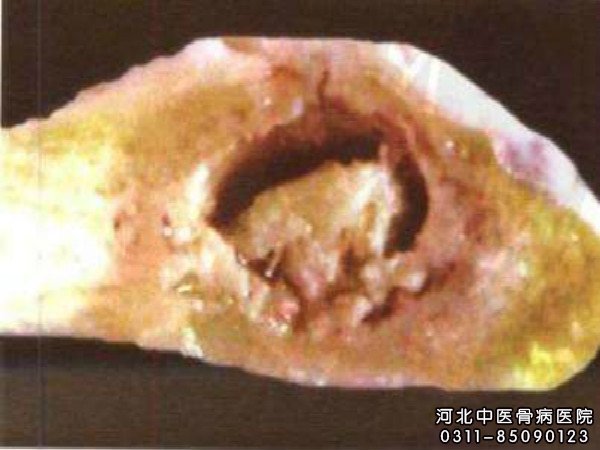 骨结核
