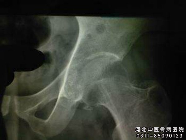 骨结核