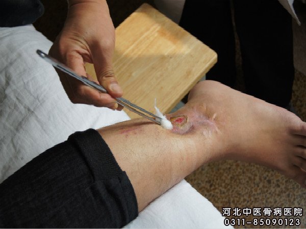 骨髓炎