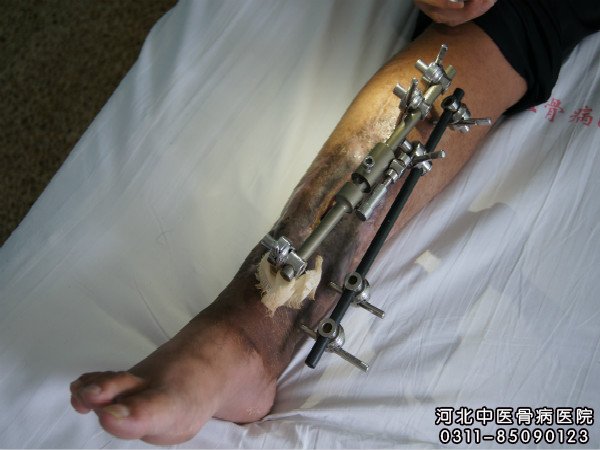 骨髓炎