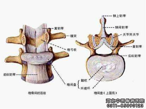 椎间盘突出