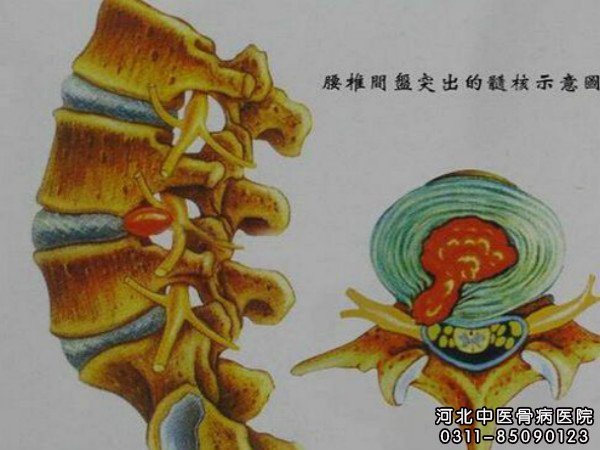 腰突