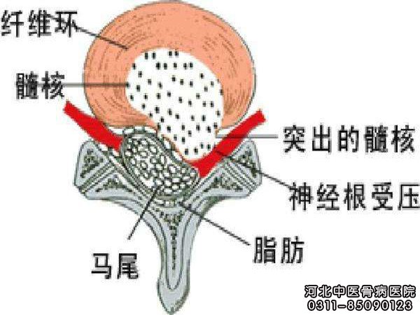 腰间盘突出