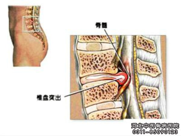 腰椎间盘突出