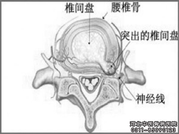 腰突