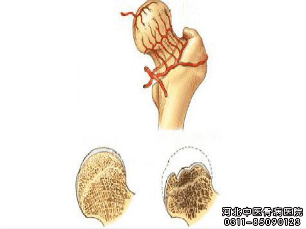 股骨头坏死