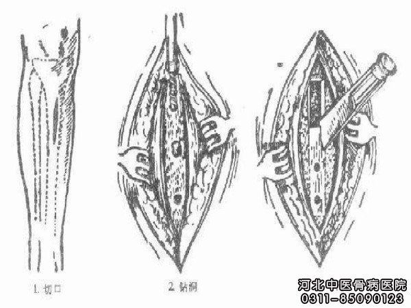 骨髓炎