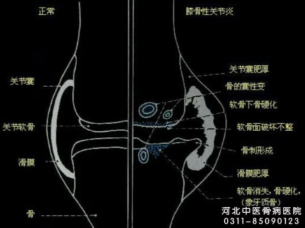 滑膜炎