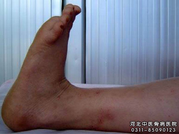 骨髓炎
