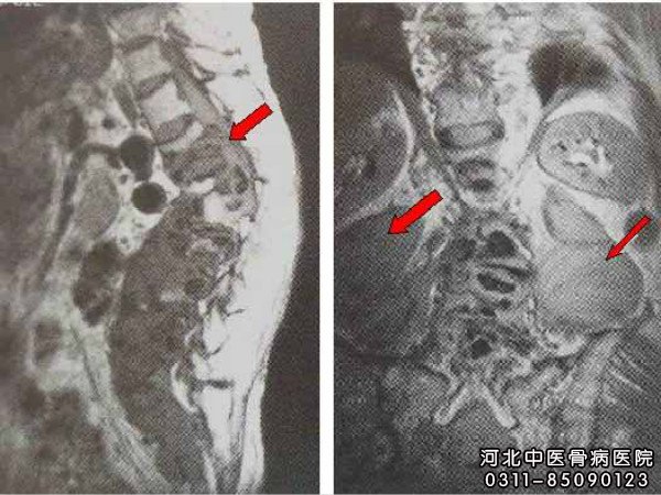 脊椎骨骨髓炎