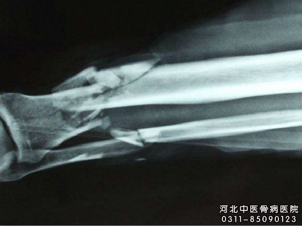 骨髓炎