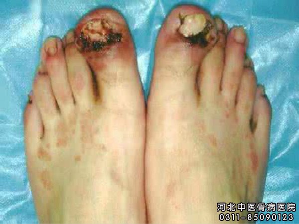 骨髓炎