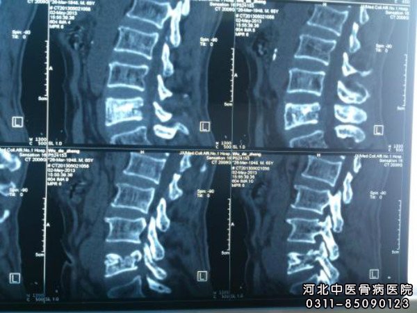 腰椎结核