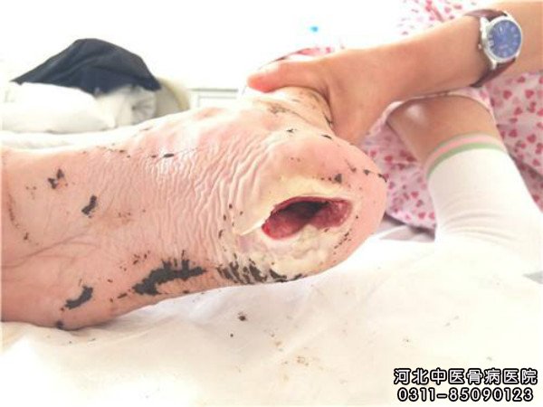 骨髓炎