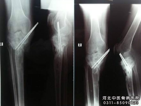 骨髓炎