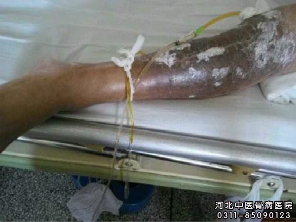 骨髓炎