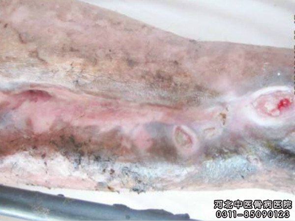 骨髓炎