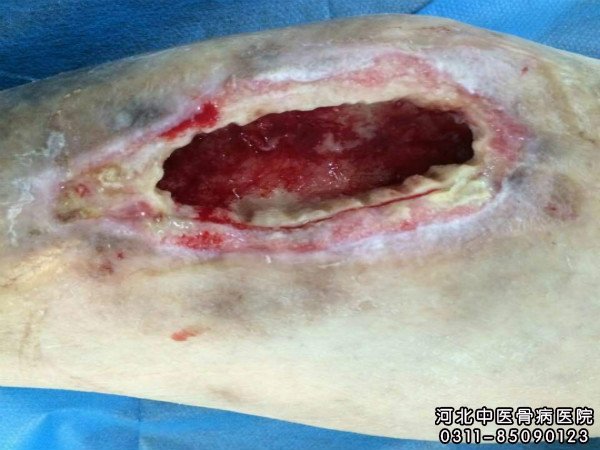 骨髓炎