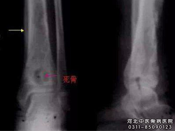 骨髓炎X线