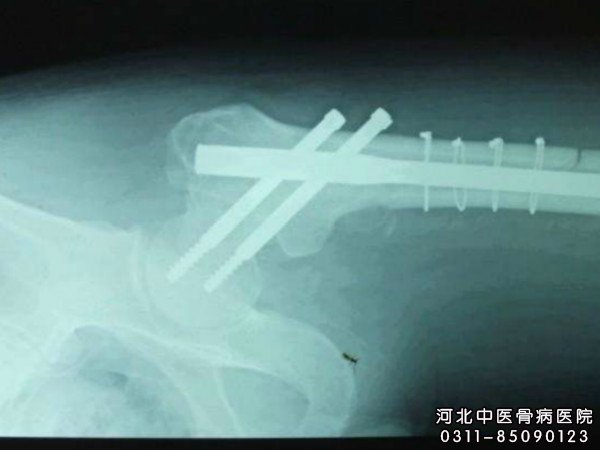 骨髓炎
