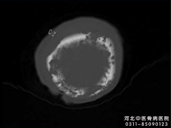 颅骨骨髓炎